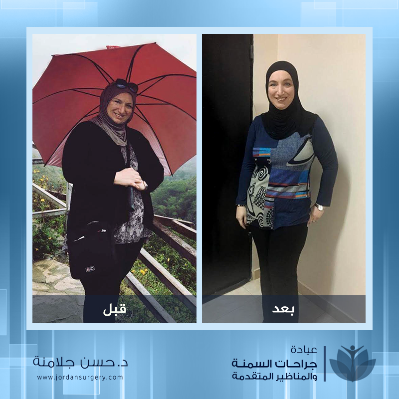 Before and after weight loss صور قبل و بعد عملية التكميم